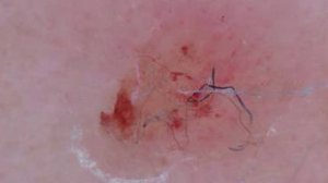 Morgellons fibers embedded in skin. PHOTO: PLOS ONE